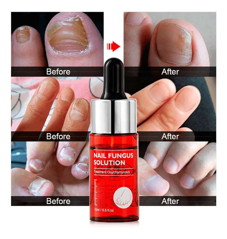 1x Happy Nails Fungal Nail Treatment Toenail Fungus Removal