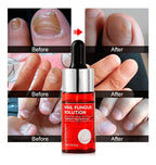 1x Happy Nails Fungal Nail Treatment Toenail Fungus Removal