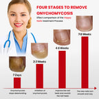 1x Happy Nails Fungal Nail Treatment Toenail Fungus Removal