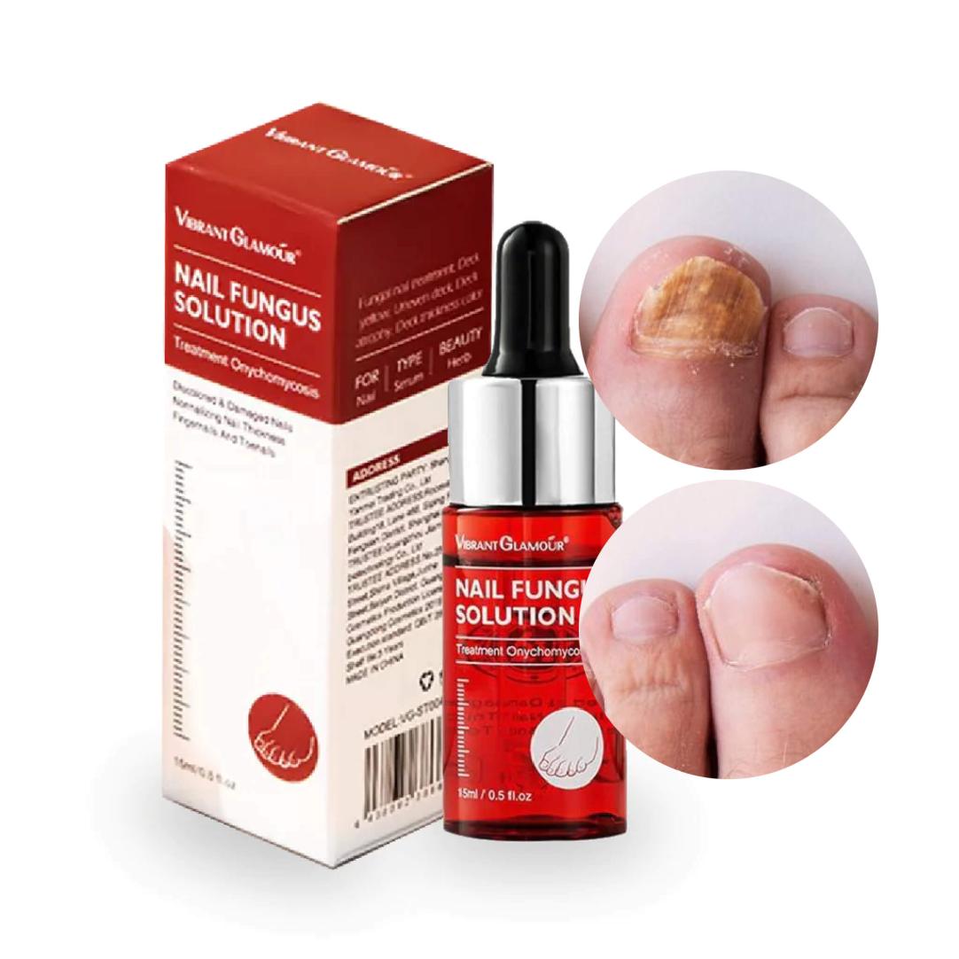 Happy Nails Toe Fungus Treatment Toe Nail Fungus Treatment Toenail Fungus Removal