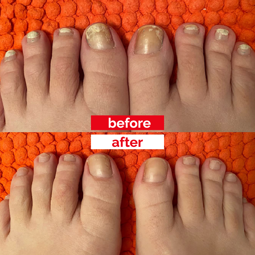 Famous Names Products - BEFORE AND AFTER IBX NAIL TREATMENT ON THE TOENAILS.  The client's toenails was discolored, dry and damaged. Just after ONE  treatment the nail plate looked less yellow, Brighter
