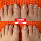 6x Happy Nails Fungal Nail Treatment Toenail Fungus Removal