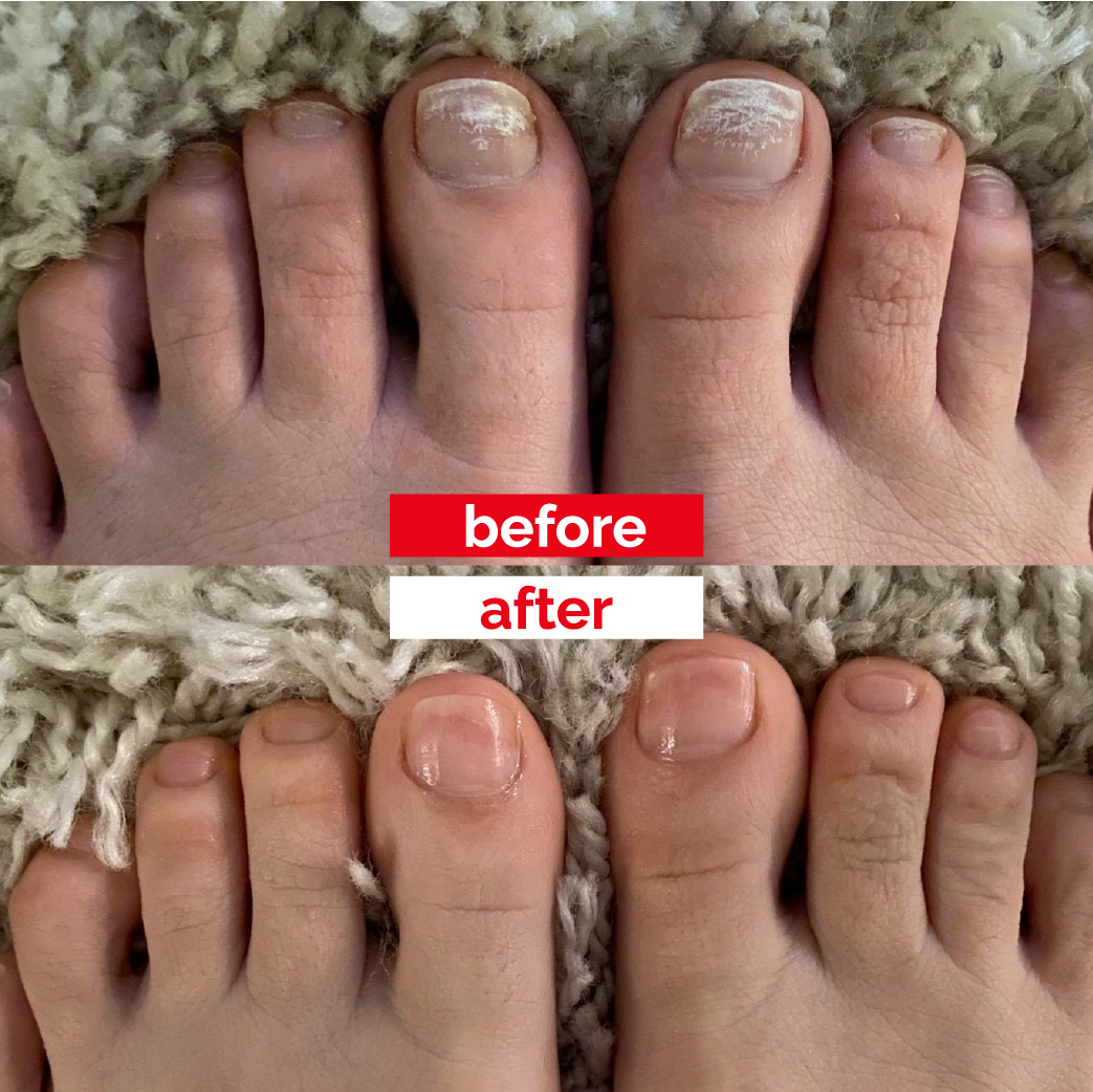 5x Happy Nails Fungal Nail Treatment Toenail Fungus Removal